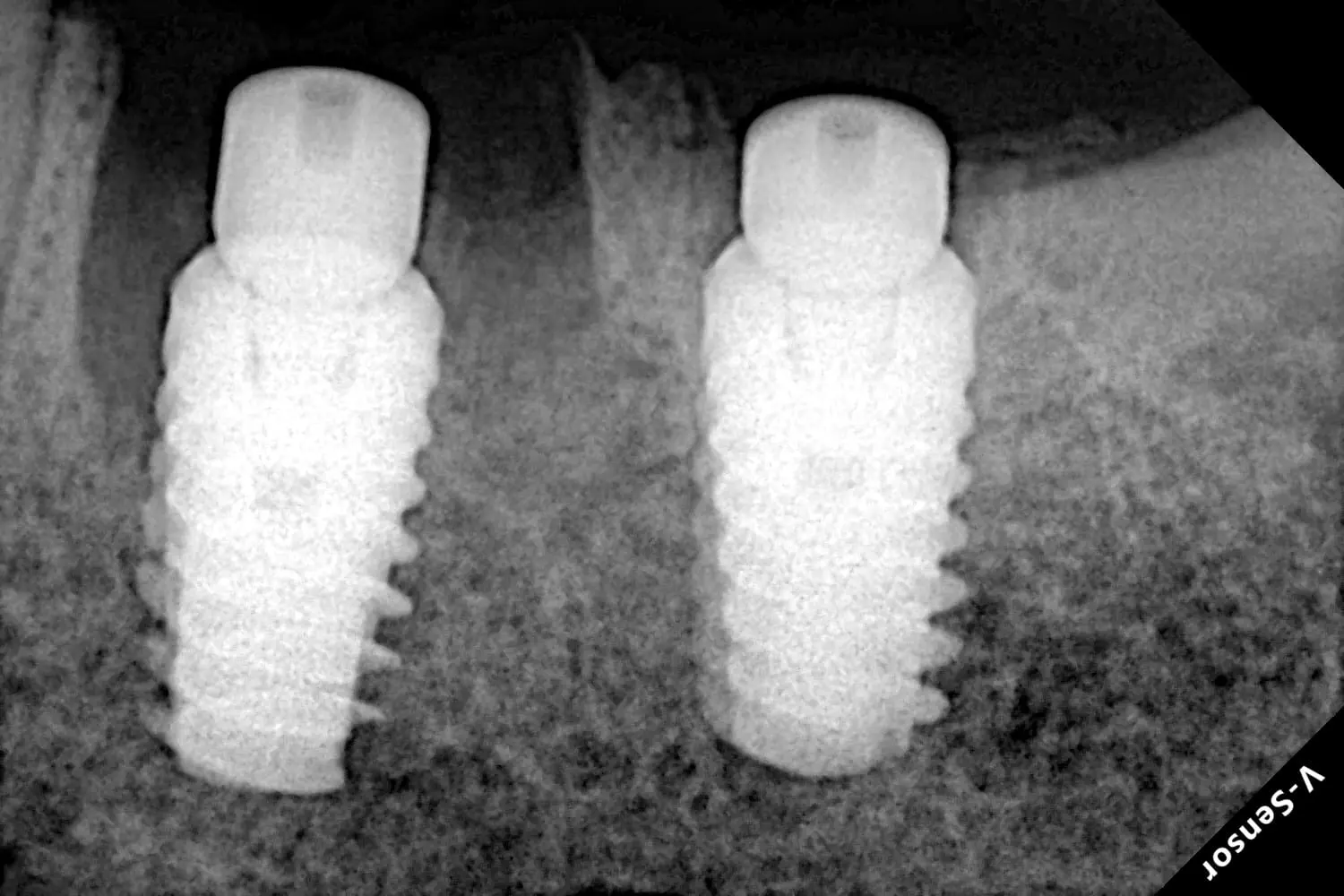 Dental Implant X-Ray - Implant case imagery that highlights precise restorative planning and treatment support.