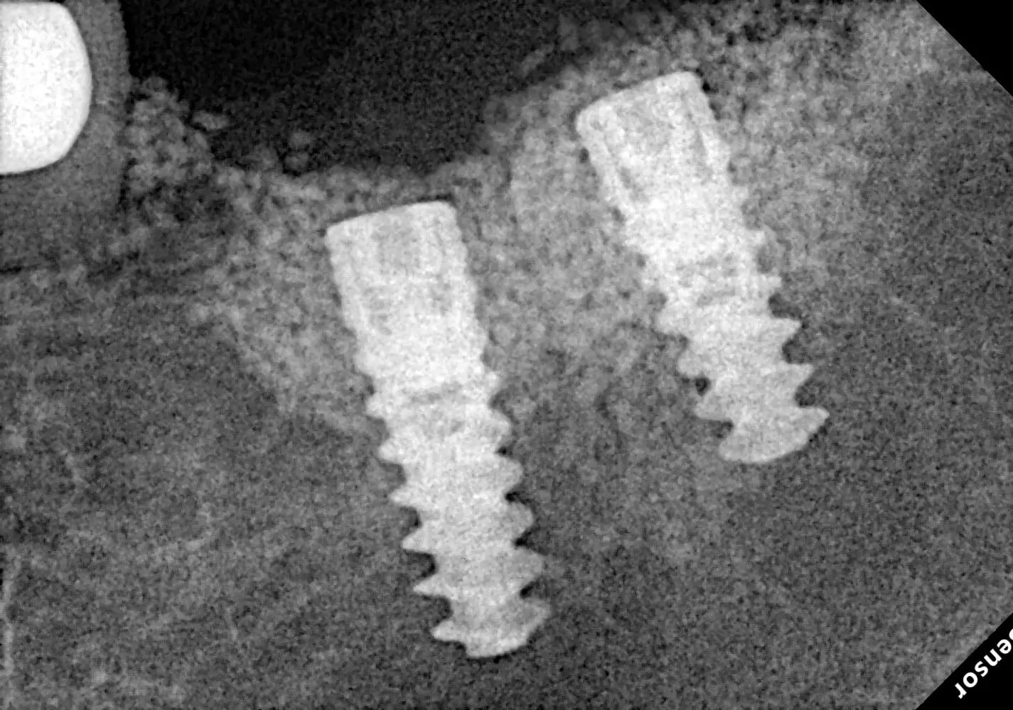 Implant Placement X-Ray - Clinical implant placement visual demonstrating advanced dental implant treatment work.