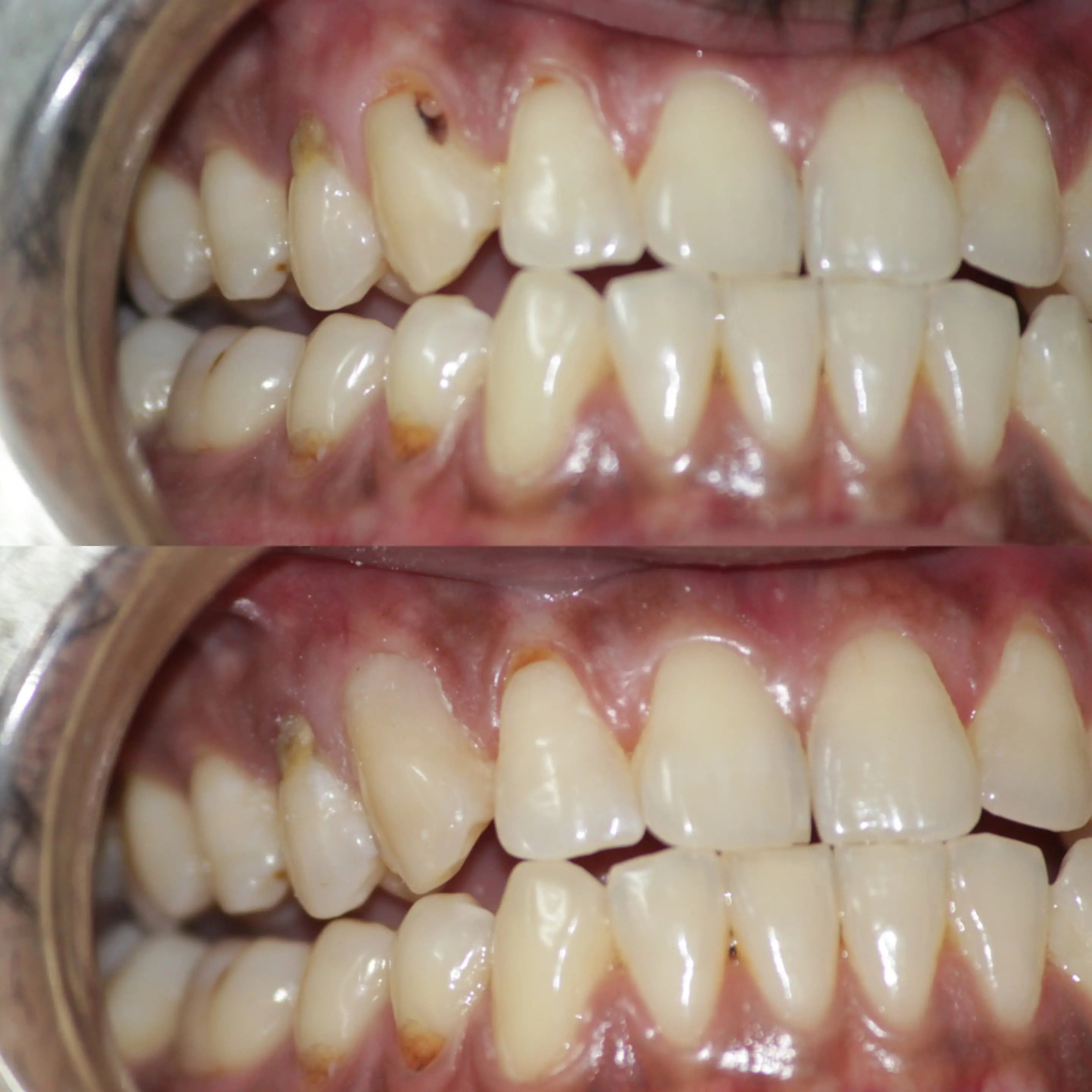 Tooth Restoration Before & After - Restorative dental work focused on improving tooth appearance, structure, and smile balance.