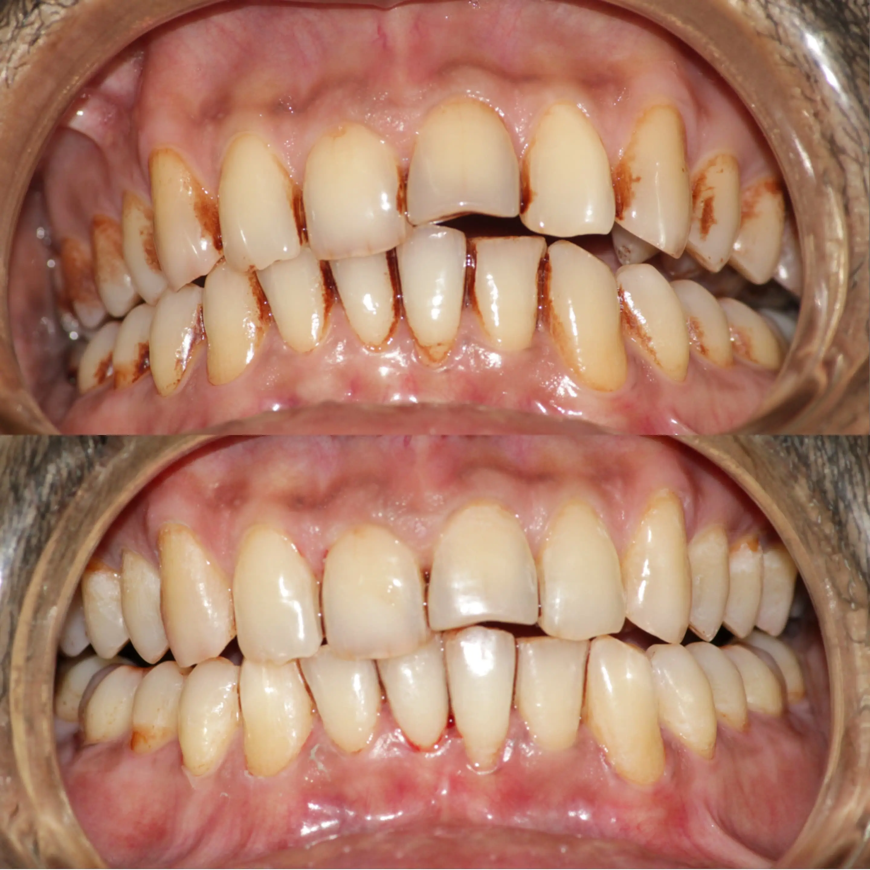 Scaling Before & After - Professional cleaning results showing clearer enamel surfaces and improved overall smile presentation.