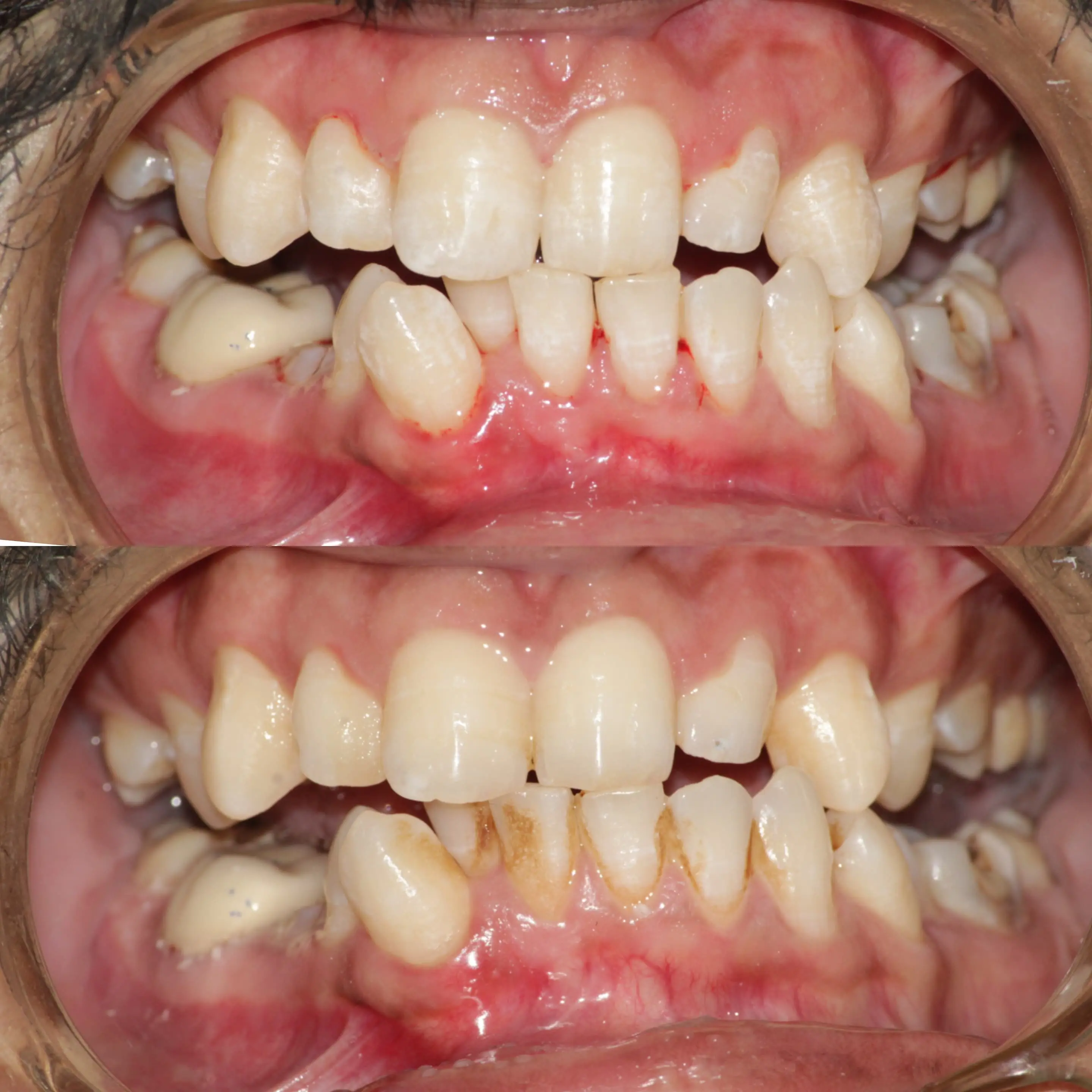 Crowding Correction Before & After - Visible smile alignment improvement that reflects the clinic’s orthodontic and smile-correction approach.