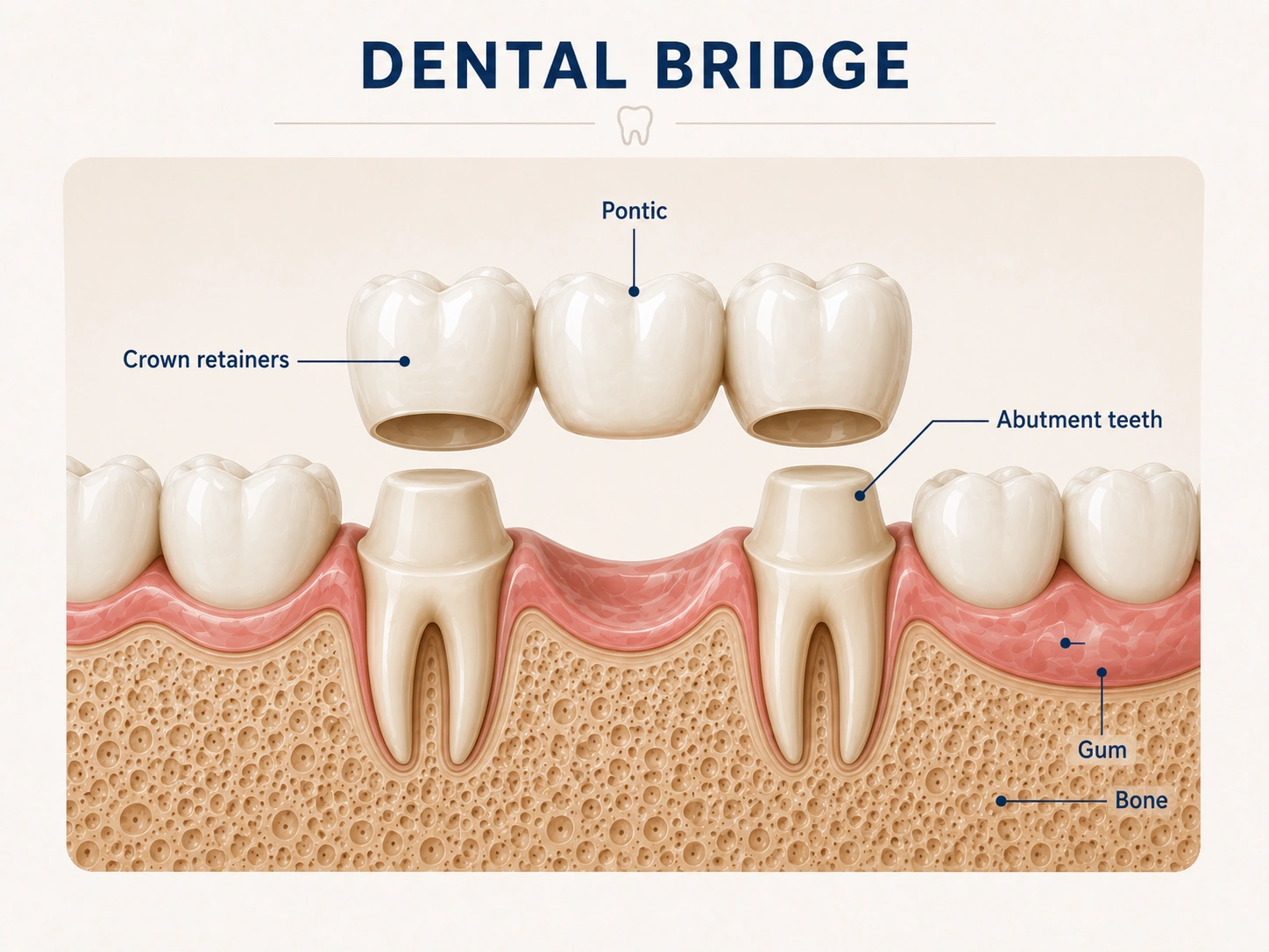 Bridges, Crowns, and Veneers (ब्रिज, कॅप आणि व्हिनिअर्स) 2